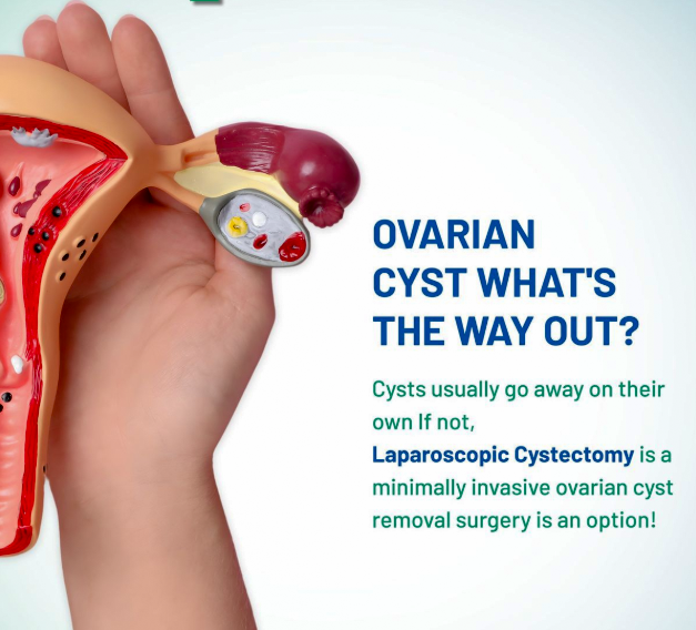 Ovarian cyst removal at Dhanya Hospitals, Rajapalayam